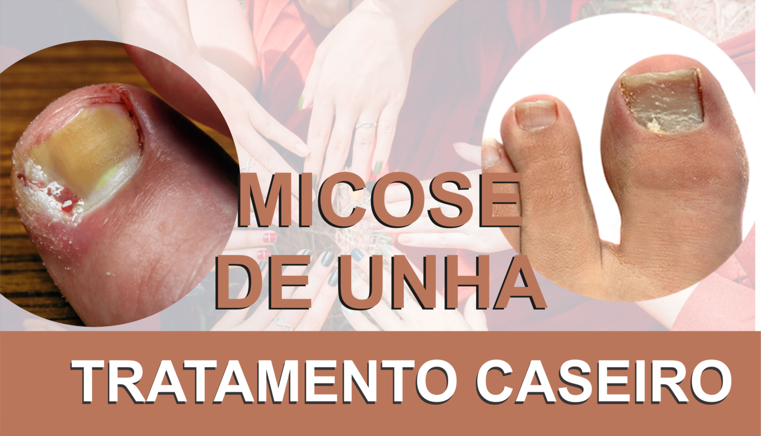 Micose De Unha, O Tratamento Caseiro Mais Eficaz. - Laguia Brasil