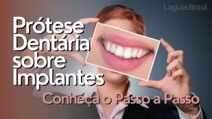 Prótese Dentária sobre Implantes - Conheça o Passo a Passo